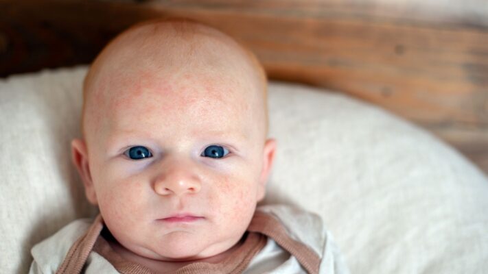 Bebeklerde Alerji Neden Olur Ay Ay Bebek Alerji Belirtileri