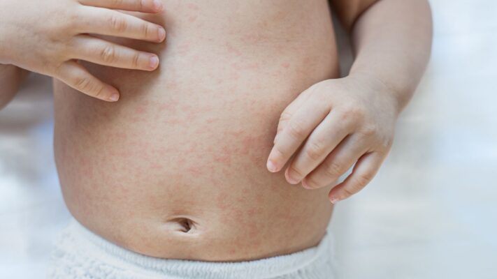 Bebeklerde Isilik Nedir Bebeklerde Isilik Nasil Gecer