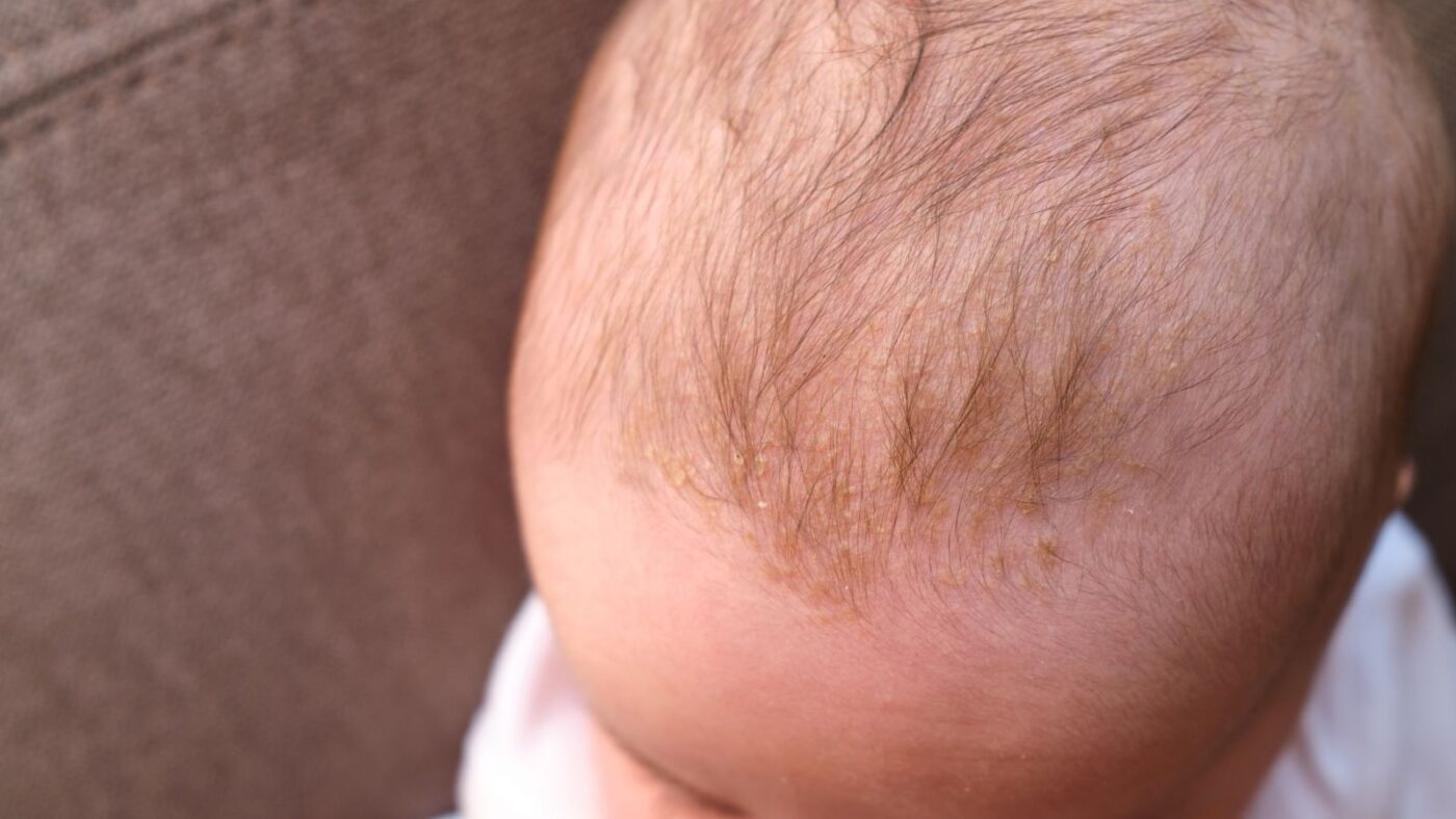 Bebeklerde Konak Sac Derisinde Pullanma Nedir Nasil Gecer