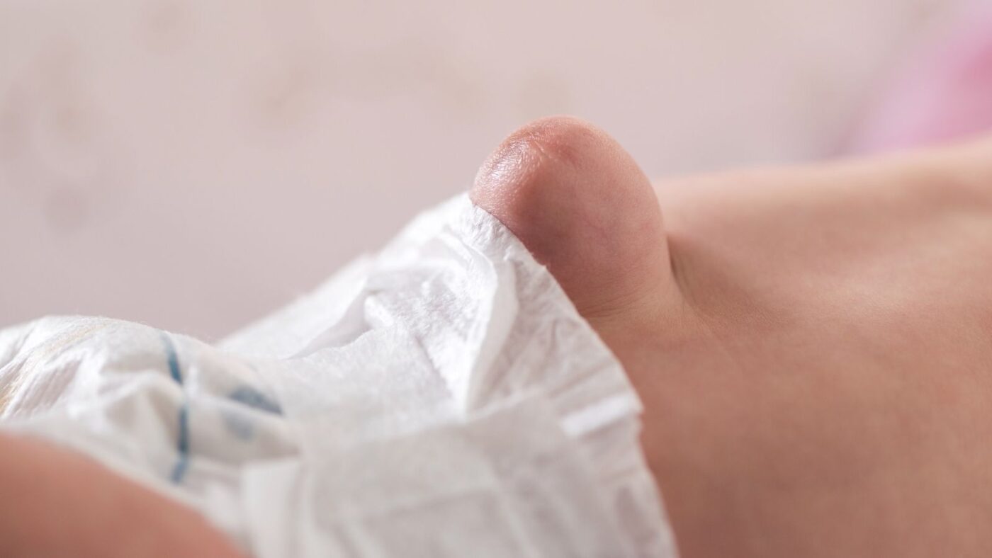 Yenidogan Bebekte Gobek Fitigi ve Kasik Fitigi