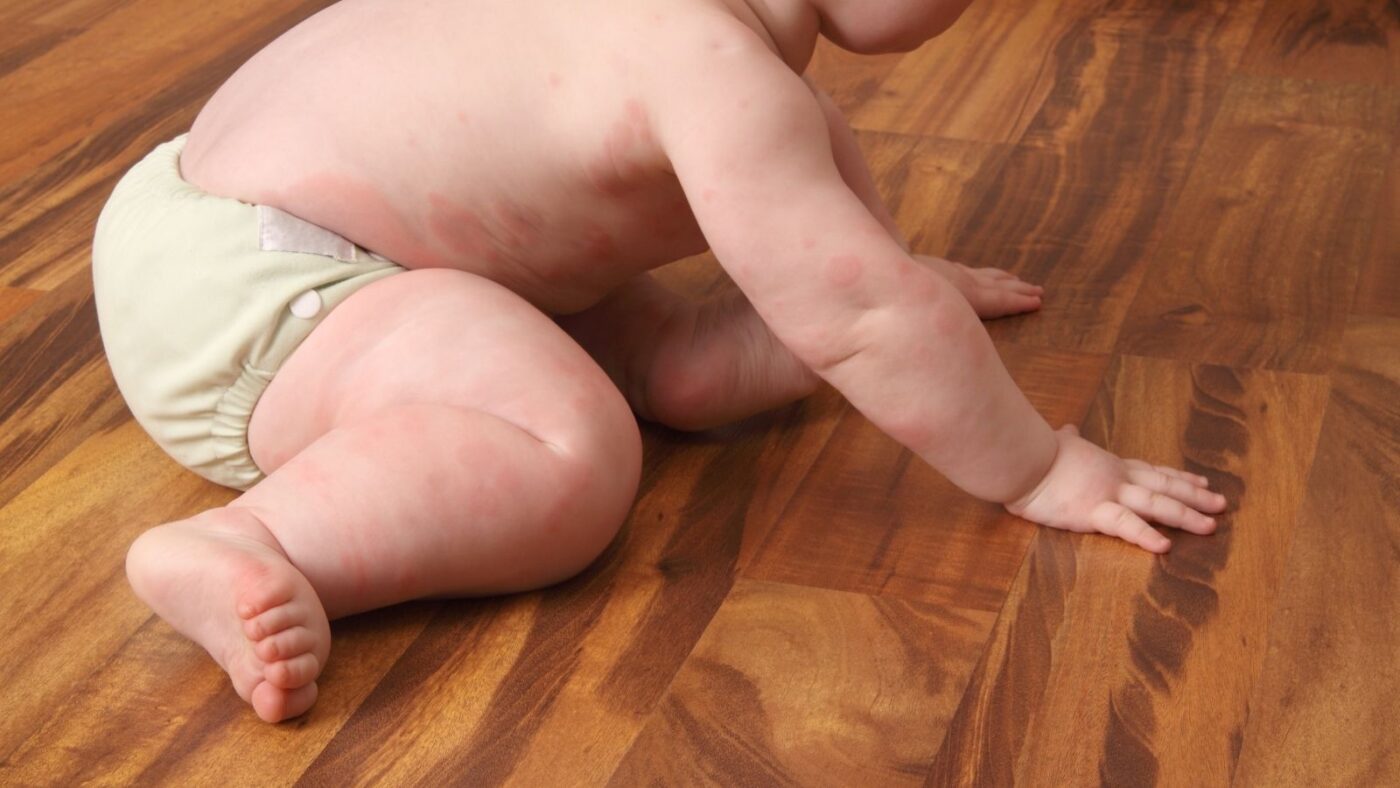 Bebeklerde Kurdesen Urtiker Neden Olur Nasil Gecer